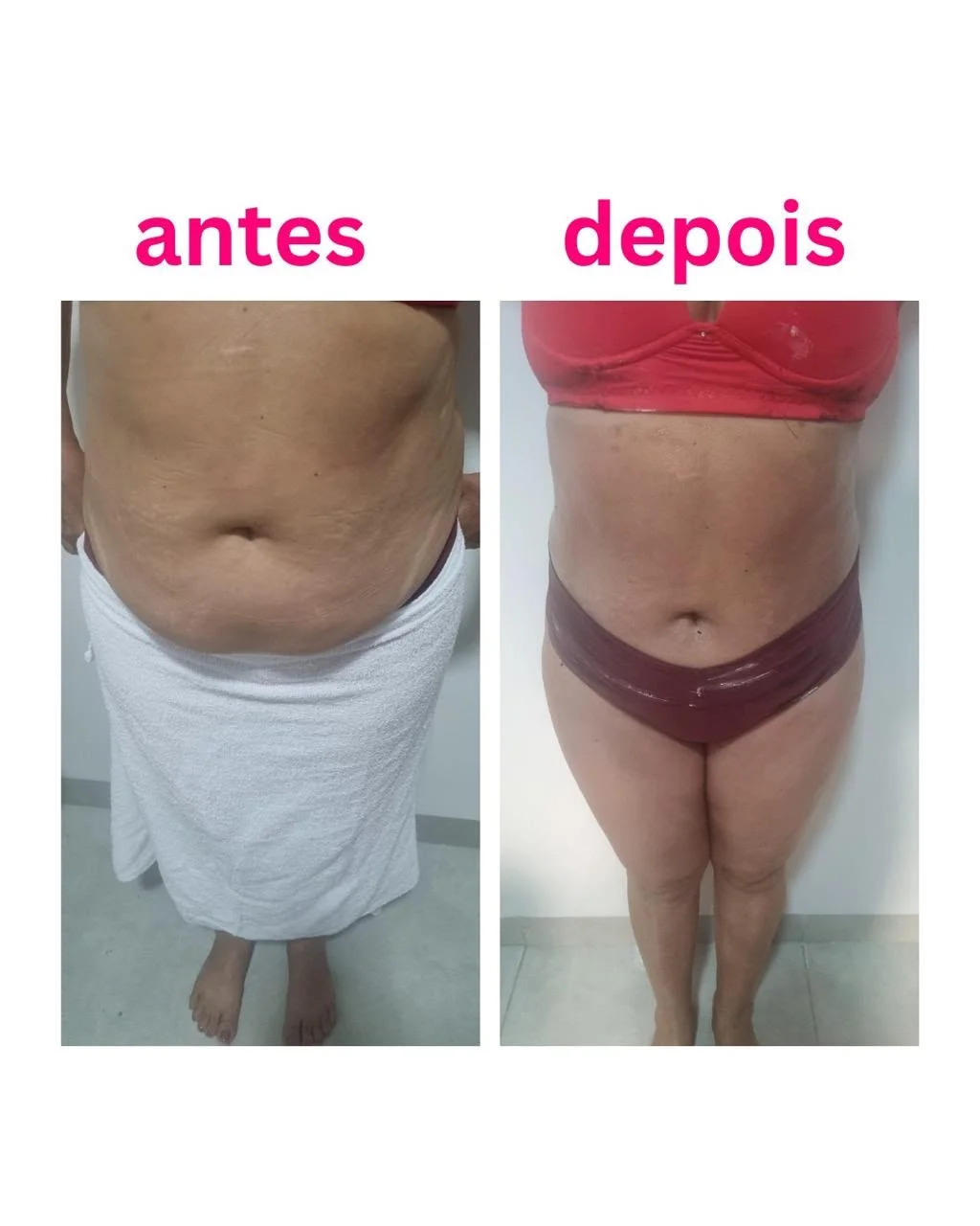 Resultado antes e depois — mudança de contorno em abdômen e flancos