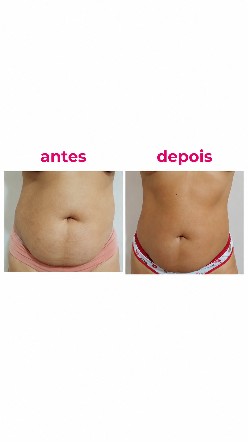 Resultado antes e depois — mudança de contorno em abdômen e flancos
