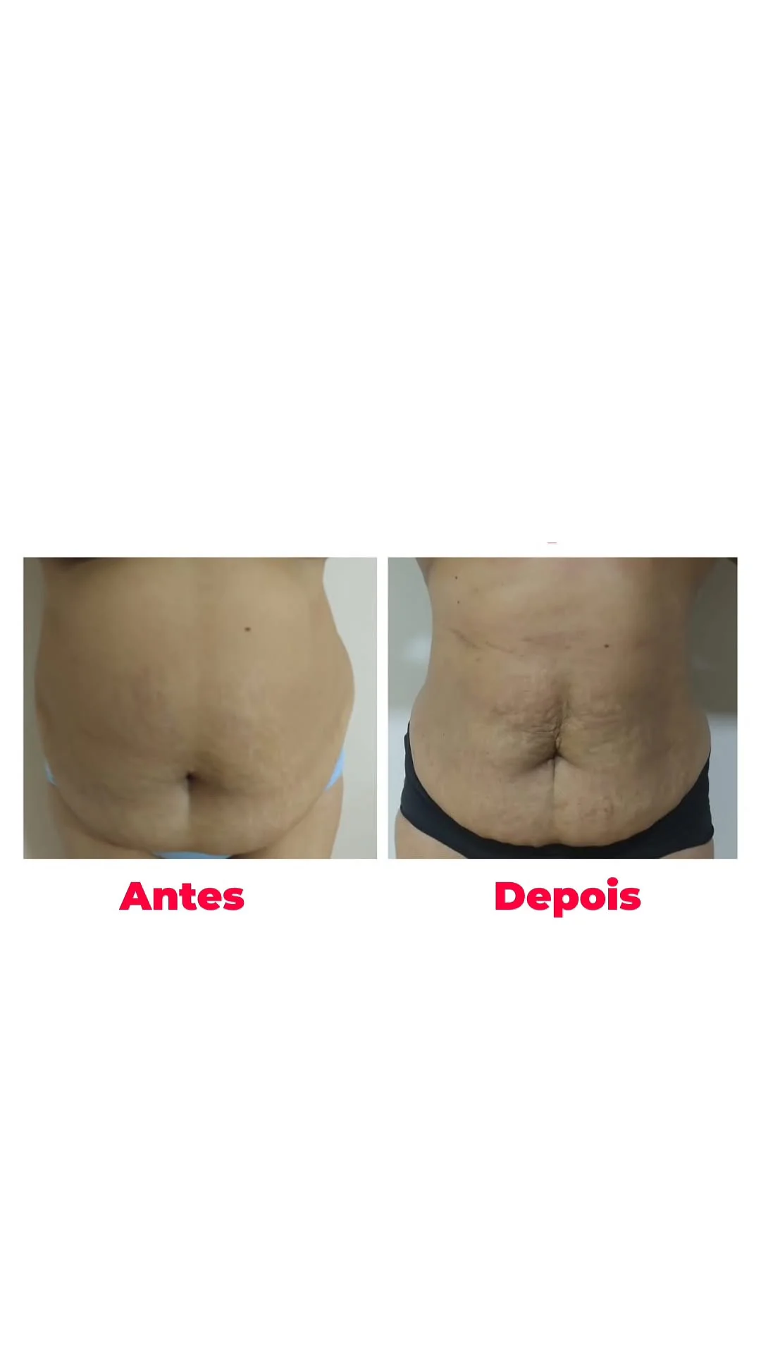 Resultado antes e depois — mudança de contorno em abdômen e flancos