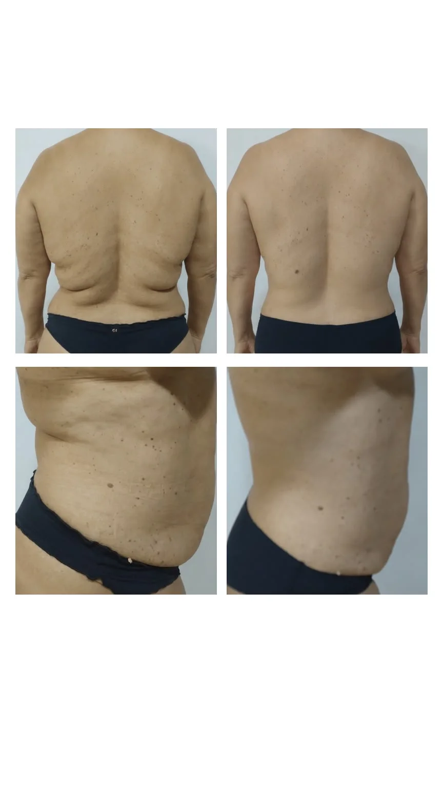 Resultado antes e depois — mudança de contorno em abdômen e flancos